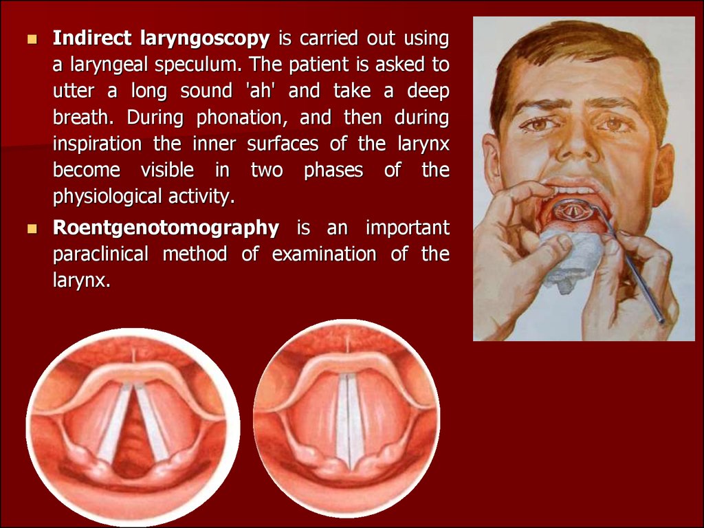 laryngoscopie